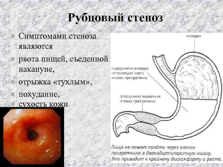 Рубцовый стеноз n n n Симптомами стеноза являются рвота пищей, съеденной накануне, отрыжка «тухлым»