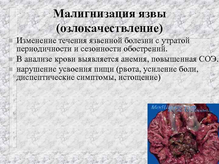 Малигнизация язвы (озлокачествление) n n n Изменение течения язвенной болезни с утратой периодичности и