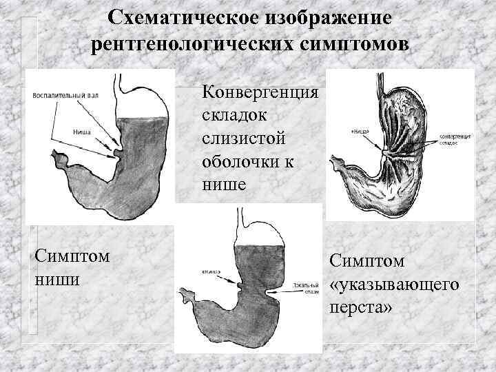 Схематическое изображение рентгенологических симптомов Конвергенция складок слизистой оболочки к нише Симптом ниши Симптом «указывающего