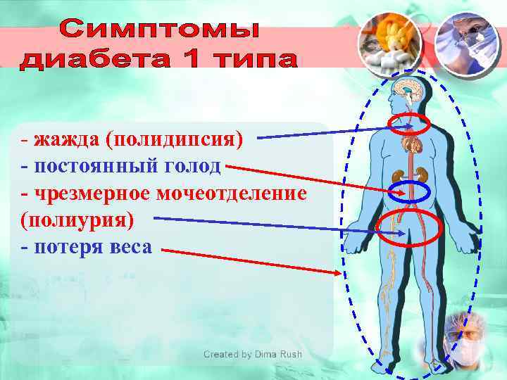 - жажда (полидипсия) - постоянный голод - чрезмерное мочеотделение (полиурия) - потеря веса 