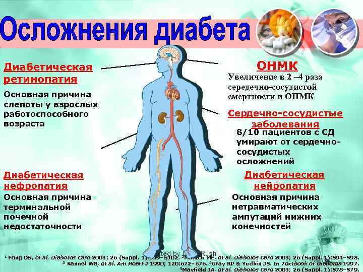 Диабетическая ретинопатия Основная причина слепоты у взрослых работоспособного возраста Диабетическая нефропатия Основная причина терминальной