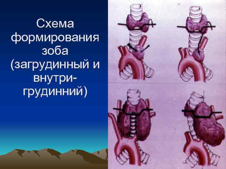 Схема формирования зоба (загрудинный и внутригрудинний) 