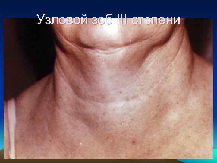 Узловой зоб III степени 