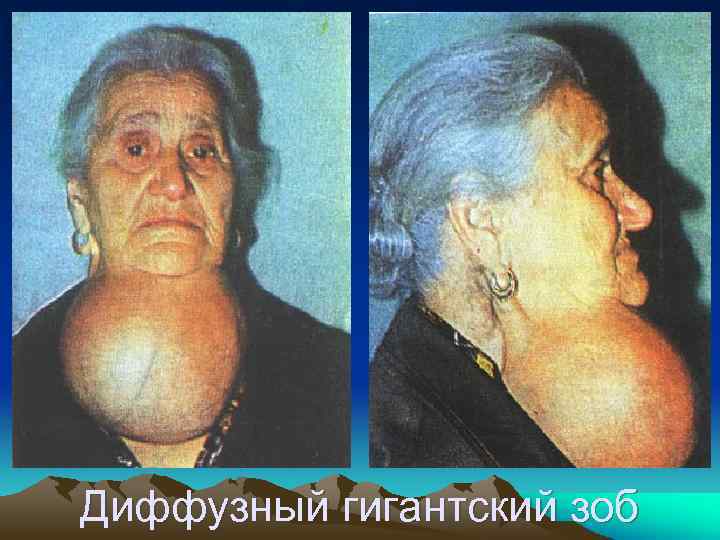 Диффузный гигантский зоб 