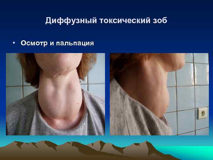 Диффузный токсический зоб • Осмотр и пальпация 