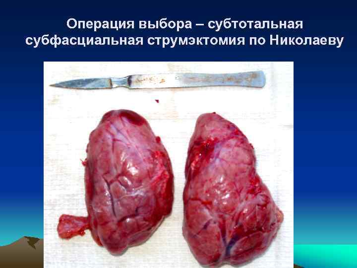 Операция выбора – субтотальная субфасциальная струмэктомия по Николаеву 