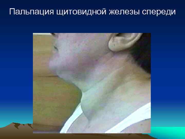 Пальпация щитовидной железы спереди 