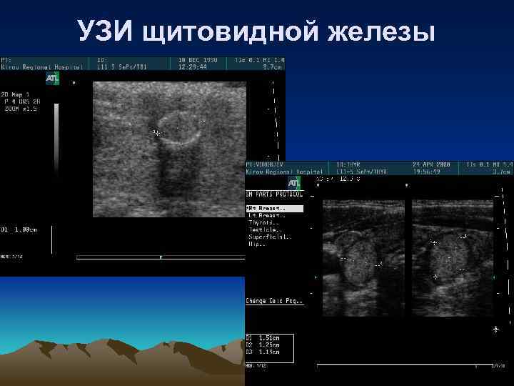 УЗИ щитовидной железы 
