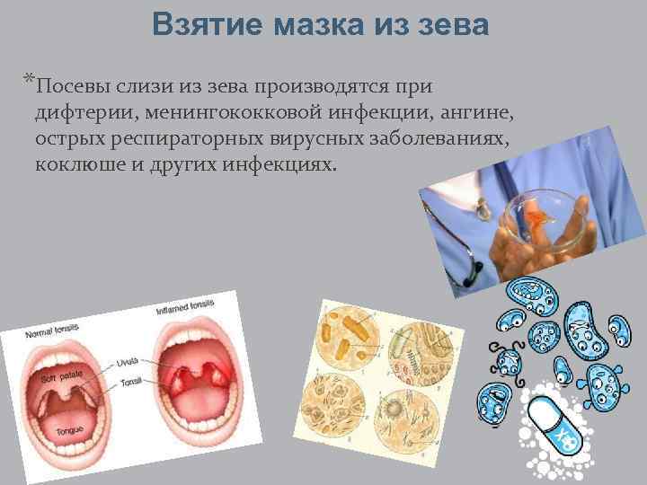 Взятие мазка из зева *Посевы слизи из зева производятся при дифтерии, менингококковой инфекции, ангине,