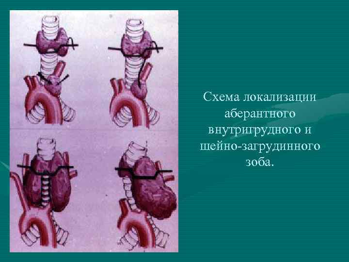Схема локализации аберантного внутригрудного и шейно-загрудинного зоба. 
