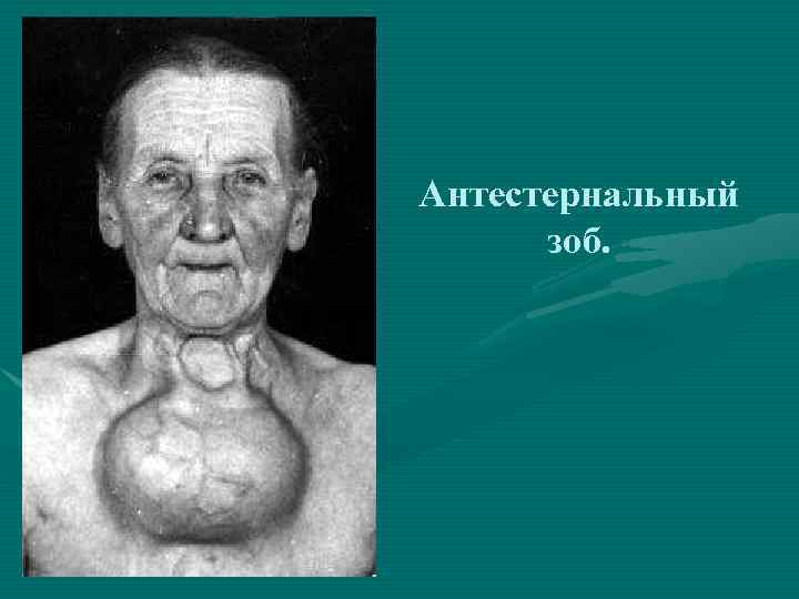 Антестернальный зоб. 