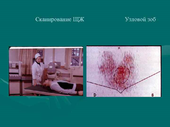 Сканирование ЩЖ Узловой зоб 