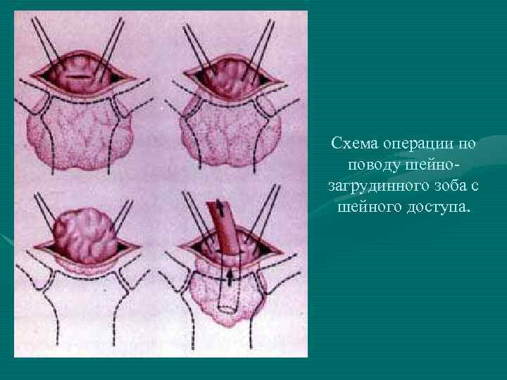 Схема операции по поводу шейнозагрудинного зоба с шейного доступа. 