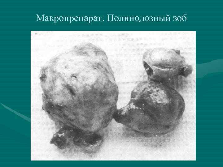 Макропрепарат. Полинодозный зоб 