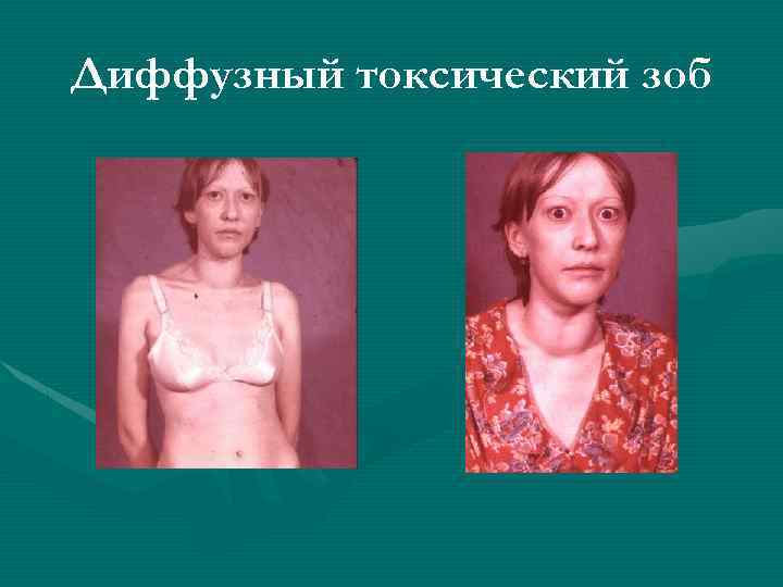 Диффузный токсический зоб 