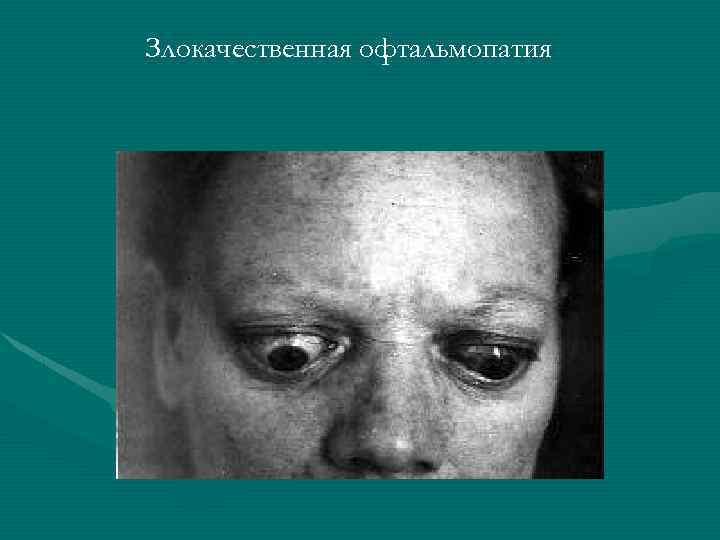 Злокачественная офтальмопатия 