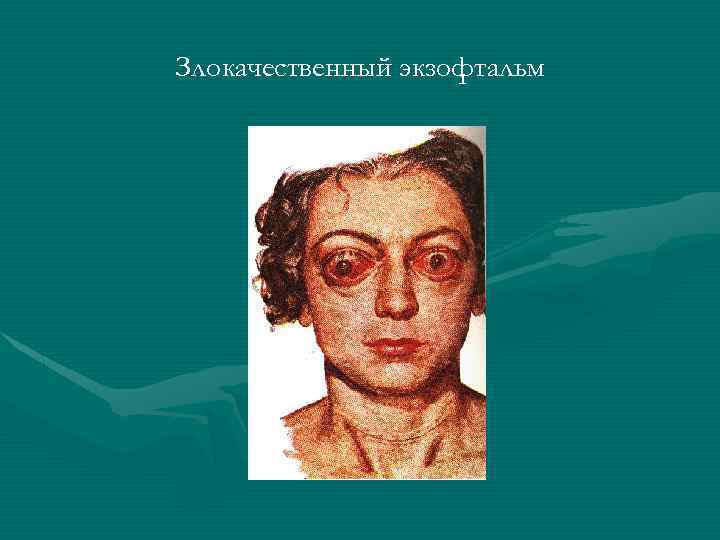 Злокачественный экзофтальм 