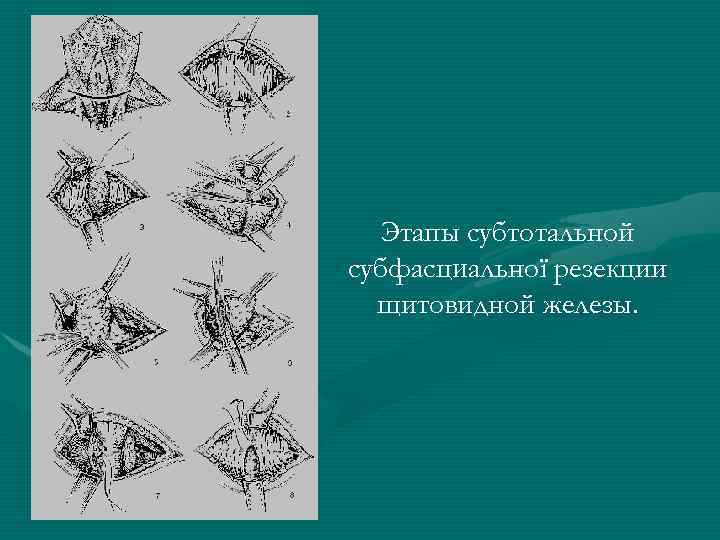 Этапы субтотальной субфасциальної резекции щитовидной железы. 