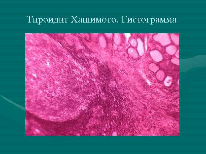 Тироидит Хашимото. Гистограмма. 