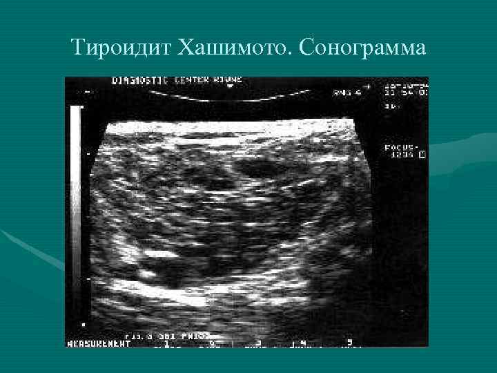Тироидит Хашимото. Сонограмма 