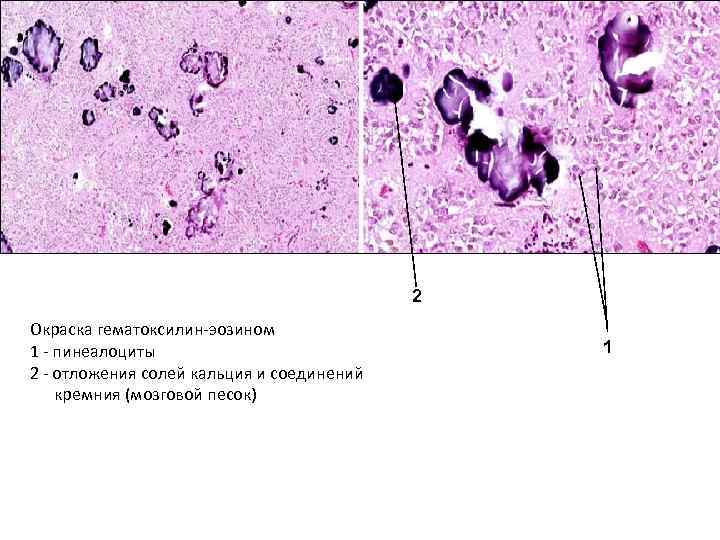 2 Окраска гематоксилин-эозином 1 - пинеалоциты 2 - отложения солей кальция и соединений кремния
