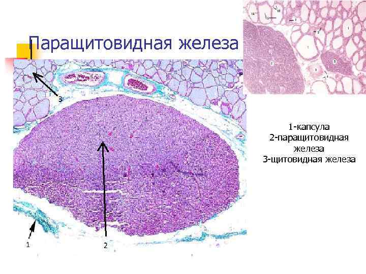 Паращитовидная железа 1 -капсула 2 -паращитовидная железа 3 -щитовидная железа 