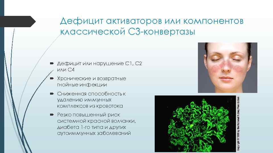 Дефицит активаторов или компонентов классической C 3 -конвертазы Дефицит или нарушение С 1, С