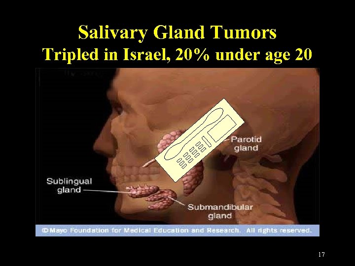 Salivary Gland Tumors Tripled in Israel, 20% under age 20 17 