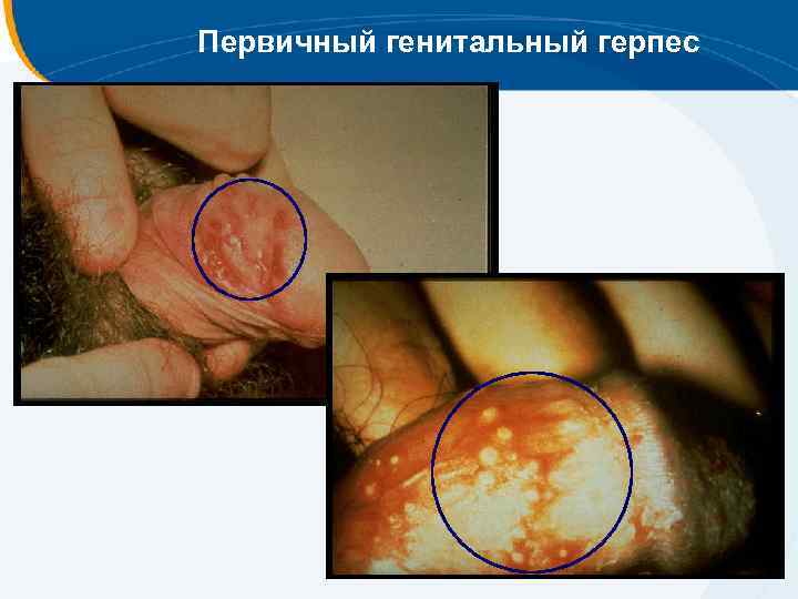 Первичный генитальный герпес 