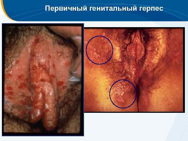 Первичный генитальный герпес 