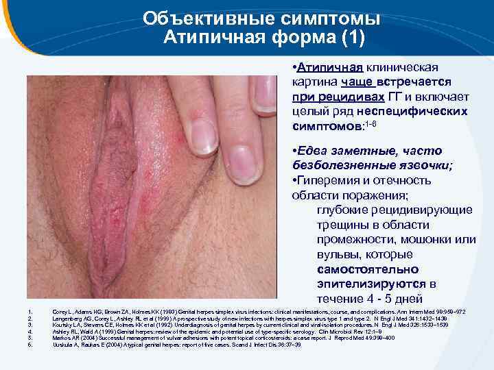 Объективные симптомы Атипичная форма (1) • Атипичная клиническая картина чаще встречается при рецидивах ГГ