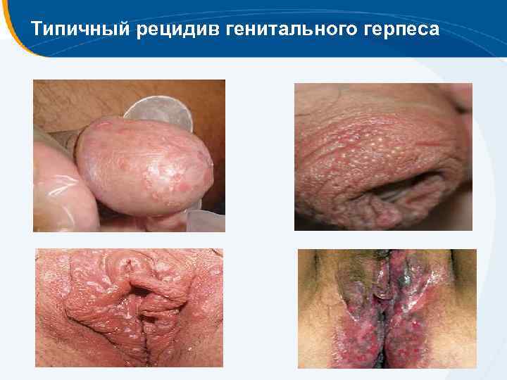 Типичный рецидив генитального герпеса 
