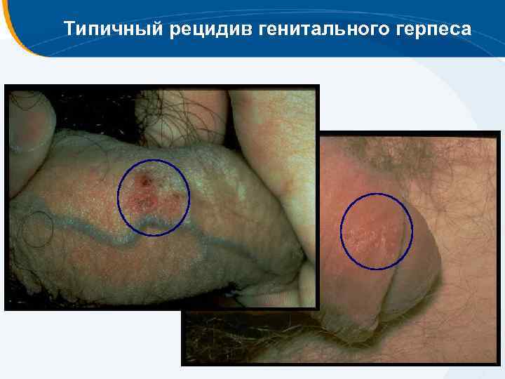 Типичный рецидив генитального герпеса 