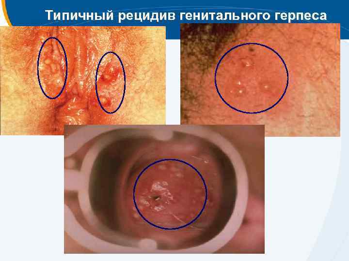 Типичный рецидив генитального герпеса 