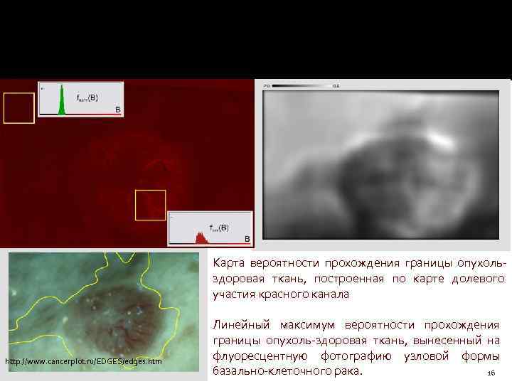 Выбор участков нормальной и опухолевой ткани. Функции распределения яркости точек, построенные для каждого из
