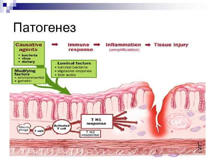 Гистологическая картина болезни крона