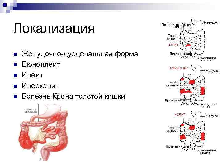 Локализация n n n Желудочно-дуоденальная форма Еюноилеит Илеоколит Болезнь Крона толстой кишки 