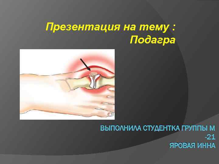 Презентация на тему : Подагра ВЫПОЛНИЛА СТУДЕНТКА ГРУППЫ М -21 ЯРОВАЯ ИННА 