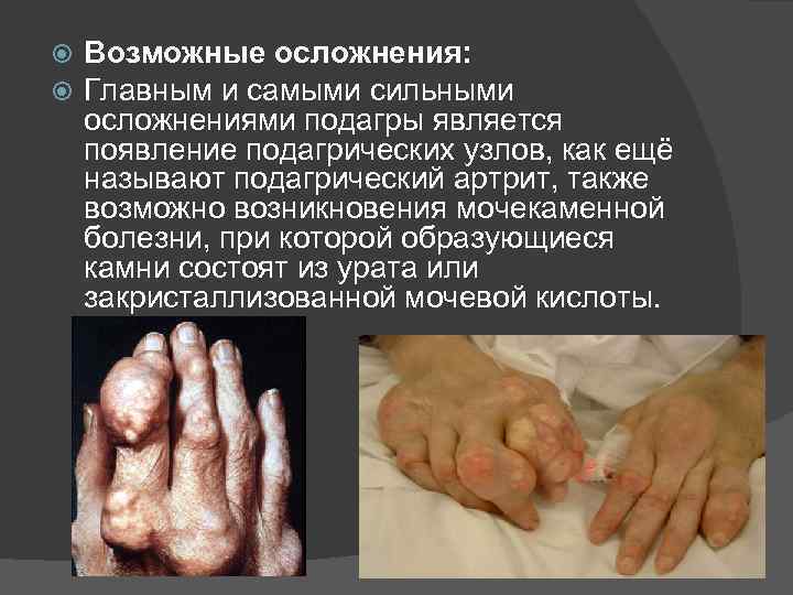  Возможные осложнения: Главным и самыми сильными осложнениями подагры является появление подагрических узлов, как