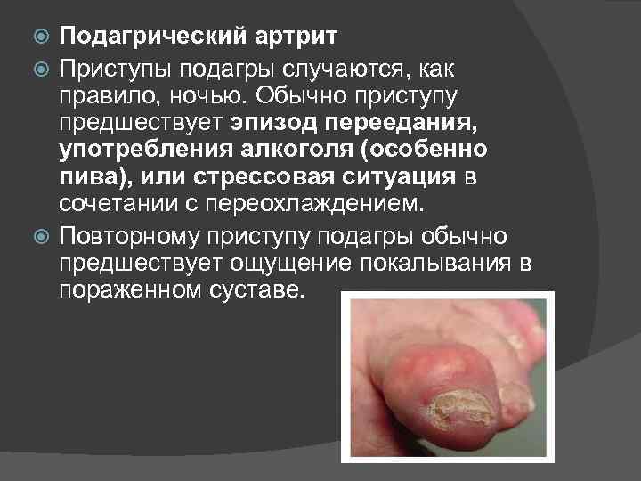 Подагрический артрит Приступы подагры случаются, как правило, ночью. Обычно приступу предшествует эпизод переедания, употребления