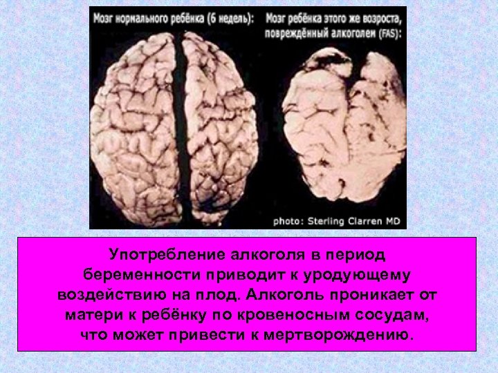 Употребление алкоголя в период беременности приводит к уродующему воздействию на плод. Алкоголь проникает от