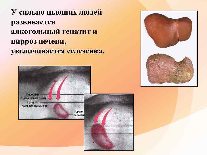 У сильно пьющих людей развивается алкогольный гепатит и цирроз печени, увеличивается селезенка. 