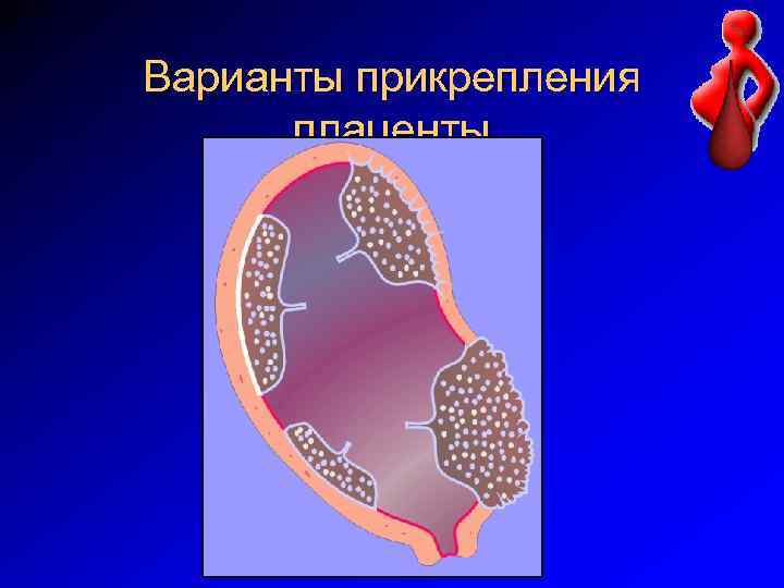 Варианты прикрепления плаценты 