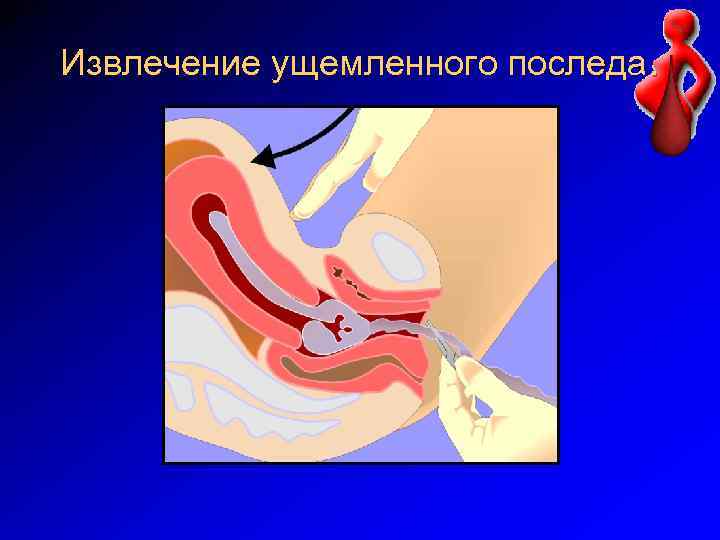 Извлечение ущемленного последа. 