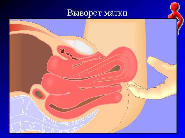 Выворот матки 