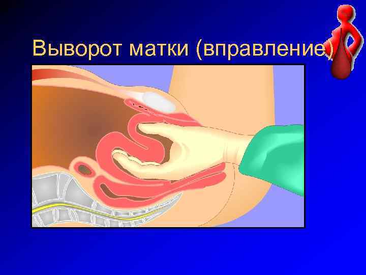 Выворот матки (вправление) 