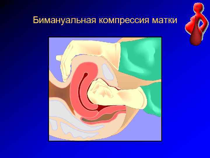 Бимануальная компрессия матки 