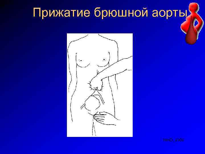 Прижатие брюшной аорты WHO, 2000 