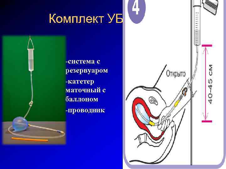 Комплект УБТ -система с резервуаром -катетер маточный с баллоном -проводник 