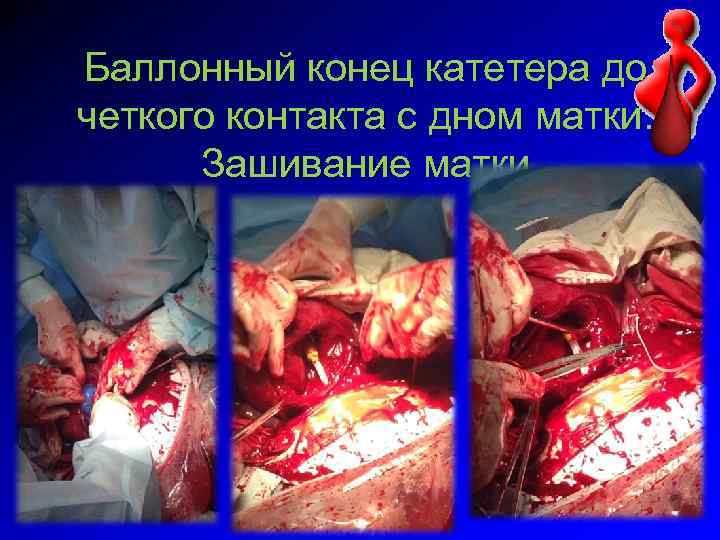 Баллонный конец катетера до четкого контакта с дном матки. Зашивание матки 